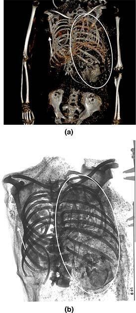 Scientists have examined the mummy of a pregnant teenage mother found in Egypt. Photo