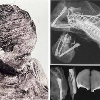 Scientists examine the mummy of a teenage mother pregnant with twins